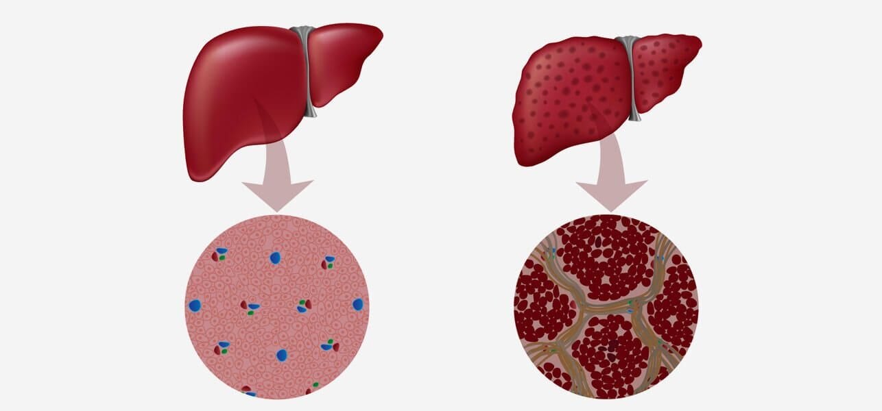 Acute On Chronic Liver Failure Market to Grow Owing to
Increasing Prevalence



Acute on chronic liv...