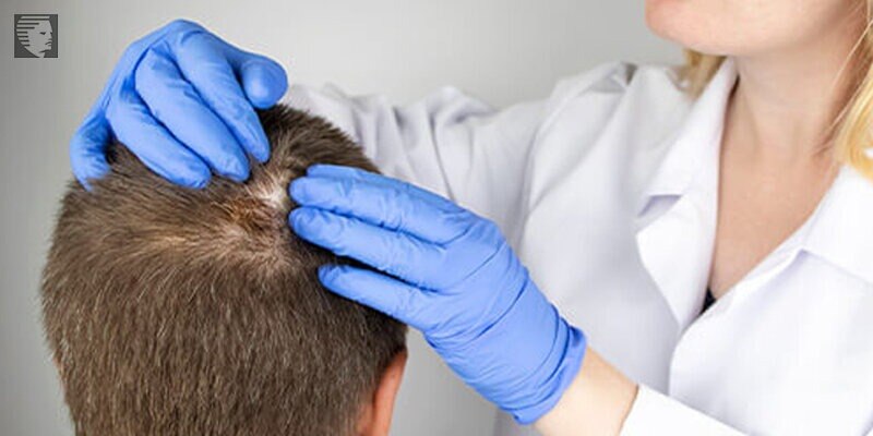 Alopecia Areata Treatment Market is Estimated to Witness
High Growth Owing to Rising Prevalence of A...