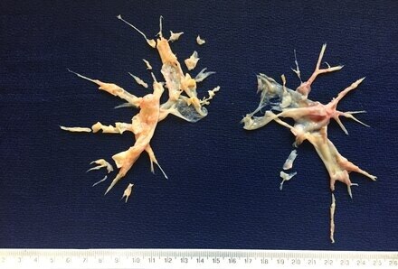 Chronic Thromboembolic Pulmonary Hypertension (CTEPH) Market
is Estimated to Witness High Growth Owi...