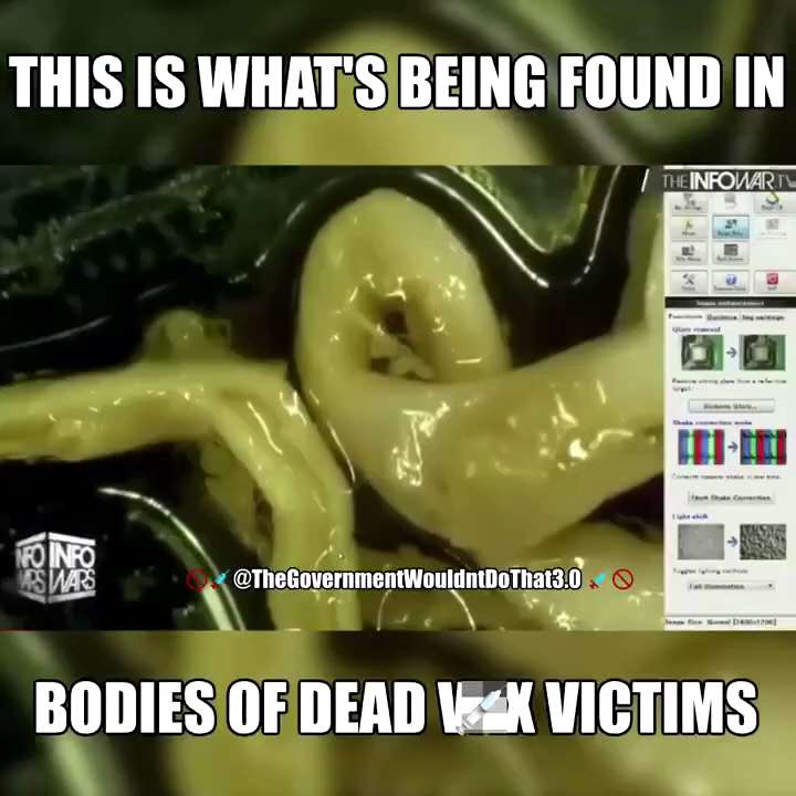 从死于新冠毒苗尸体的近心脏动脉中取出的（血）凝块，经75％酒精清洗后，至于低倍光学显微镜下观察...... 看到的是自2021年以来广泛被报道的，殡仪馆防腐师的共同发现---坚韧如橡皮筋的浅色弹性条带...