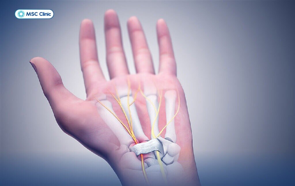 Điều trị viêm gân tay dứt điểm tại MSC International Clinic. Giải pháp y học tái tạo tiên tiến, giúp...