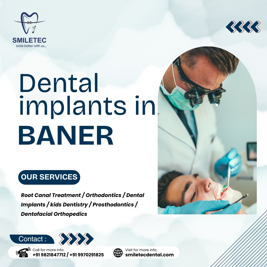 https://smiletecdental.com/dental-implants-in-baner/
