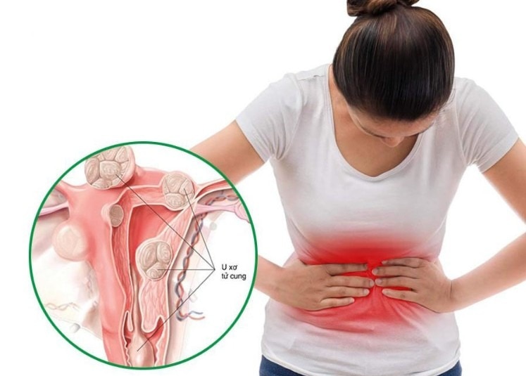 Bệnh u xơ tử cung có nguy hiểm không? Giải đáp từ chuyên gia
Bệnh u xơ tử cung là một trong những bệ...