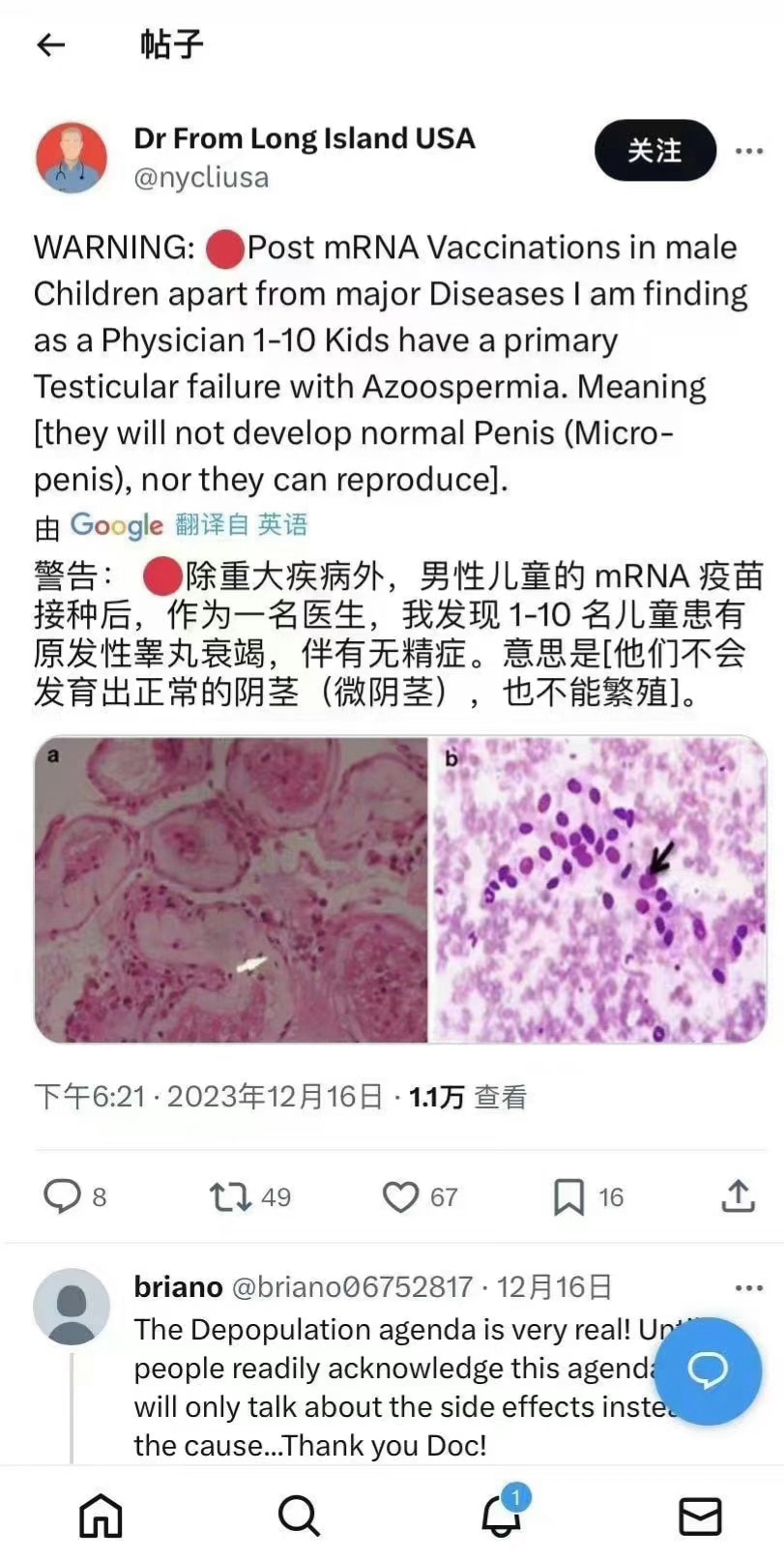 警告：•除重大疾病外，男性儿童的 mRNA 疫苗接种后，作为一名医生，我发现1-10名儿童患有原发性睾丸衰竭，伴有无精症。意思是［他们不会发育出正常的阴茎（微阴茎），也不能繁殖］。