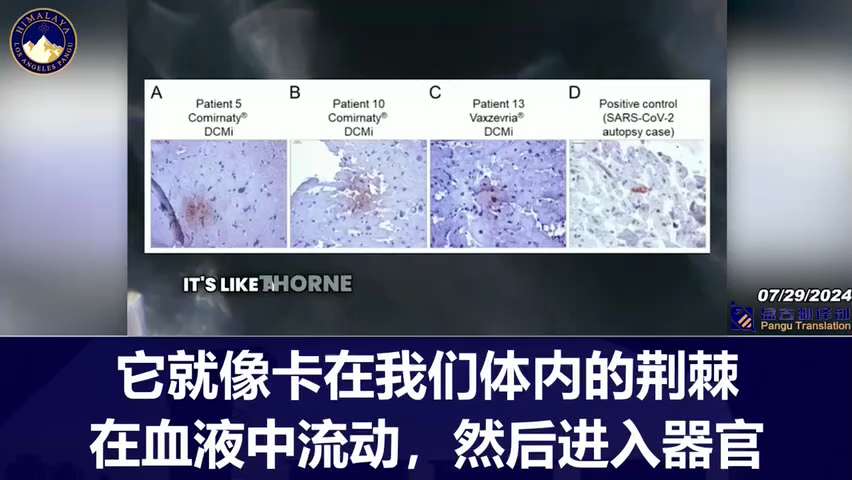 Dr. McCullough: The spike protein in both the COVID vaccines and the virus is artificially engineered and is toxic to most organ systems.
麦卡洛博士：COVID疫苗和病毒中的刺突蛋白都是人工设计的，对大多数器官系统都有毒性。
#NFSC #TakeDownTheCCP #fauci 
#WuhanLab #BiochemicalWarfare #viccinesideeffects #VaccineInjury
#ivermectin #Artemisinin #FDA #NIH #CDC #mRNA
