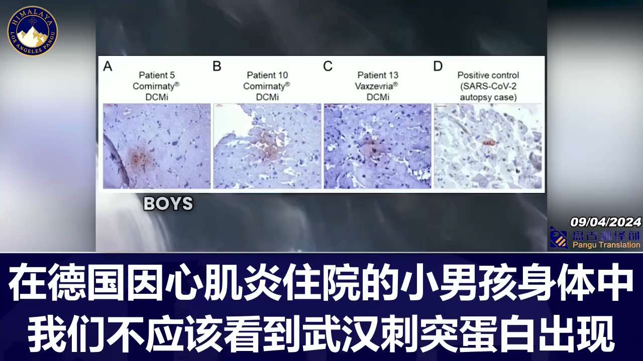 Direct evidence that COVID-19 vaccines damage the heart:
(1): Vaccine mRNA with inflammation found directly in the heart
(2): Spike protein causing inflammation found directly in the heart
(3): Pfizer and Moderna directly damage cardiomyocytes in vitro
COVID-19 疫苗损害心脏🫀的直接证据：
（1）：心脏中直接发现具有炎症的疫苗mRNA
（2）：在心脏中直接发现的引起炎症的刺突蛋白
（3）：辉瑞和 Moderna 在体外直接损害心肌细胞
#盘古翻译部