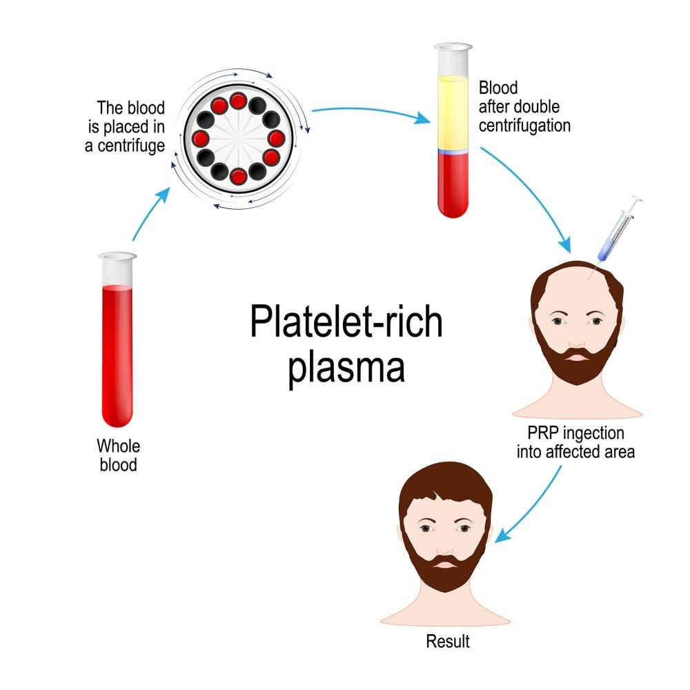 PRP Hair Restoration Vancouver—Natural Hair Regrowth

Discover PRP hair restoration in Vancouver at ...