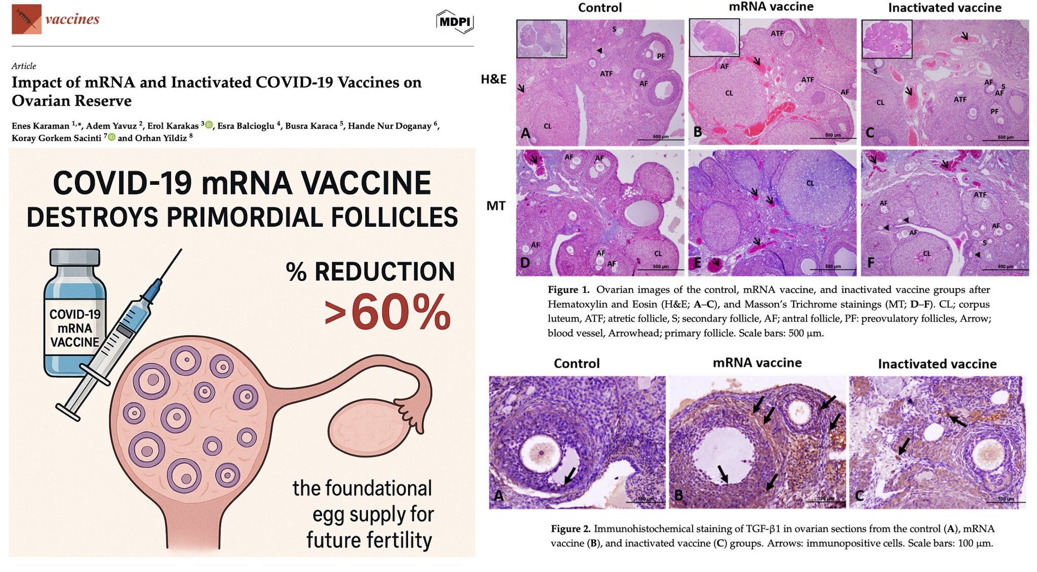 #疫苗灾难
🚨 突发新闻：新冠 mRNA 疫苗摧毁了超过 60% 的女性不可再生的卵子供应

新研究发现，肌肉注射与人类剂量相当的 mRNA 的大鼠，其原始卵泡——生育能力的基础——发生了不可逆的丧...