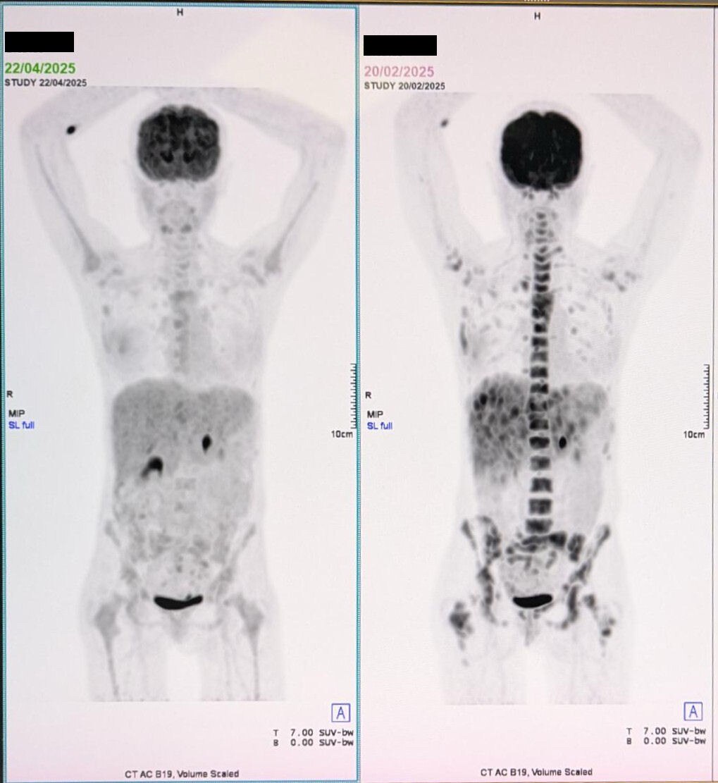 🔥抗癌奇迹！49岁澳洲女性战胜4期乳腺癌！ 🩷  

一位49岁的澳大利亚女性，确诊4期乳腺癌，癌细胞已转移至骨骼、淋巴和肝脏，情况危急。😔 但她没有放弃！从2025年2月中旬开始，她每天坚持使...