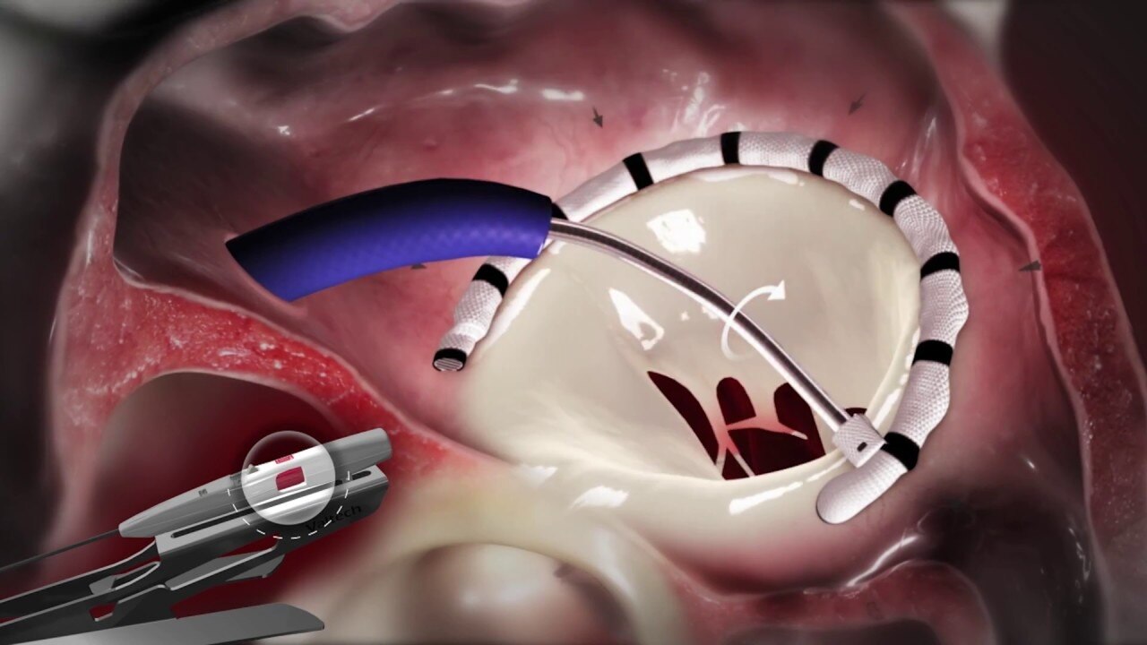 Mitral Valve Annuloplasty Rings Market to Soar with Minimally Invasive Ring Designs



 Mitral valve...