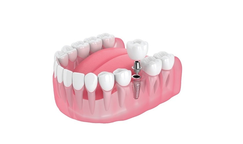 Trồng răng Implant giá rẻ nhất – Có nên lựa chọn? Phân tích chuyên sâu từ Nha khoa Sing 

Chi phí là...