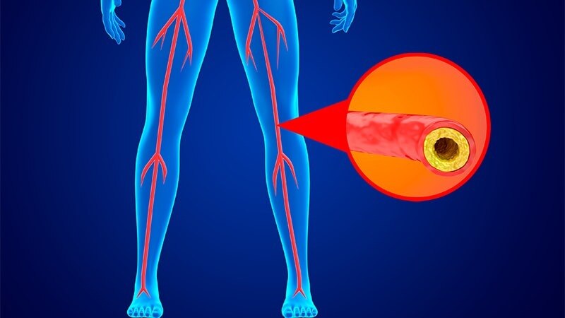 Peripheral Artery Disease (PAD) Market to Surge with Advanced Drug-Eluting Stents

 Peripheral arter...