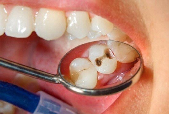 Trám răng có bền không? Câu trả lời đầy đủ từ chuyên gia nha khoa
Trám răng là một trong những kỹ th...