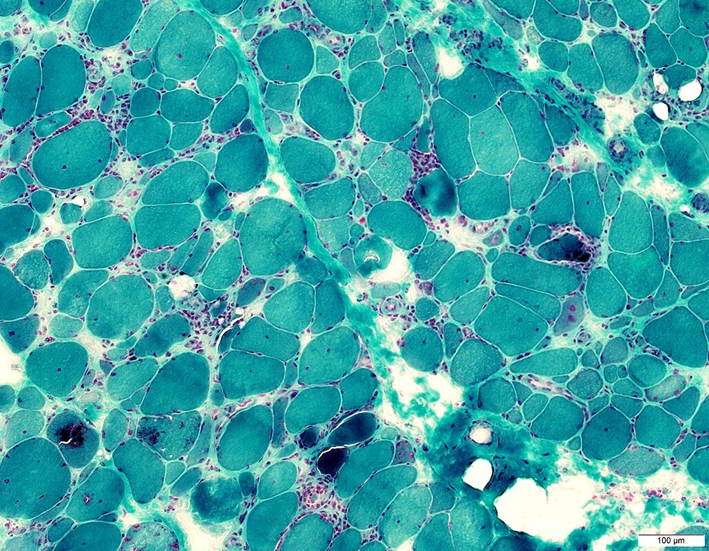 Inclusion Body Myositis Market to Witness Growth Owing to
R&D Investments



Inclusion Body Myositis...