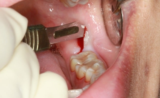 Nhổ răng khôn đau mấy ngày? Giải đáp từ chuyên gia giúp bạn yên tâm trước khi nhổ 

Nhiều người khi ...