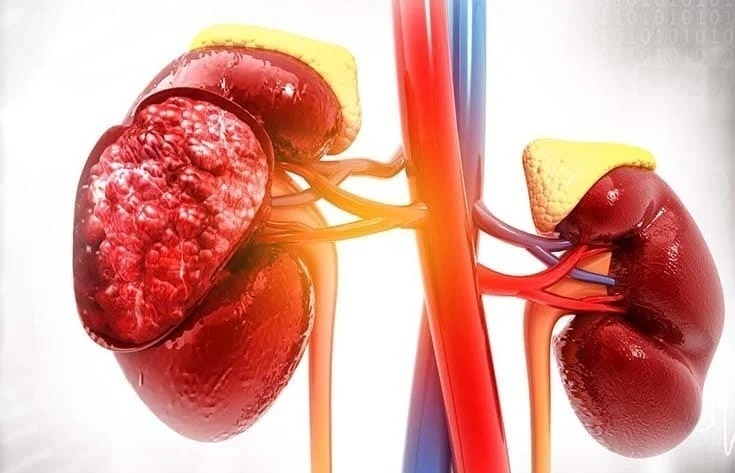 Kidney Specialist in Jaipur | Without Dialysis Treatment