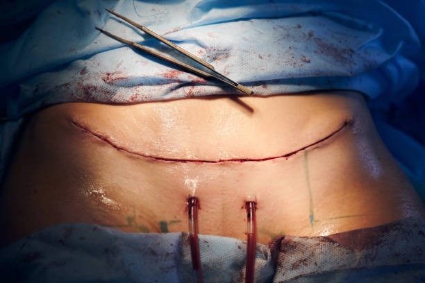 Abdominoplastika pēc grūtniecības un svara zuduma

Abdominoplastika palīdz atjaunot vēdera formu pēc...