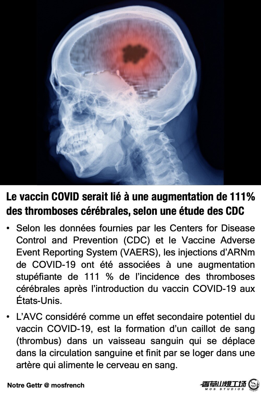 Le vaccin COVID serait lié à une augmentation de 111% des thromboses cérébrales, selon une étude des...