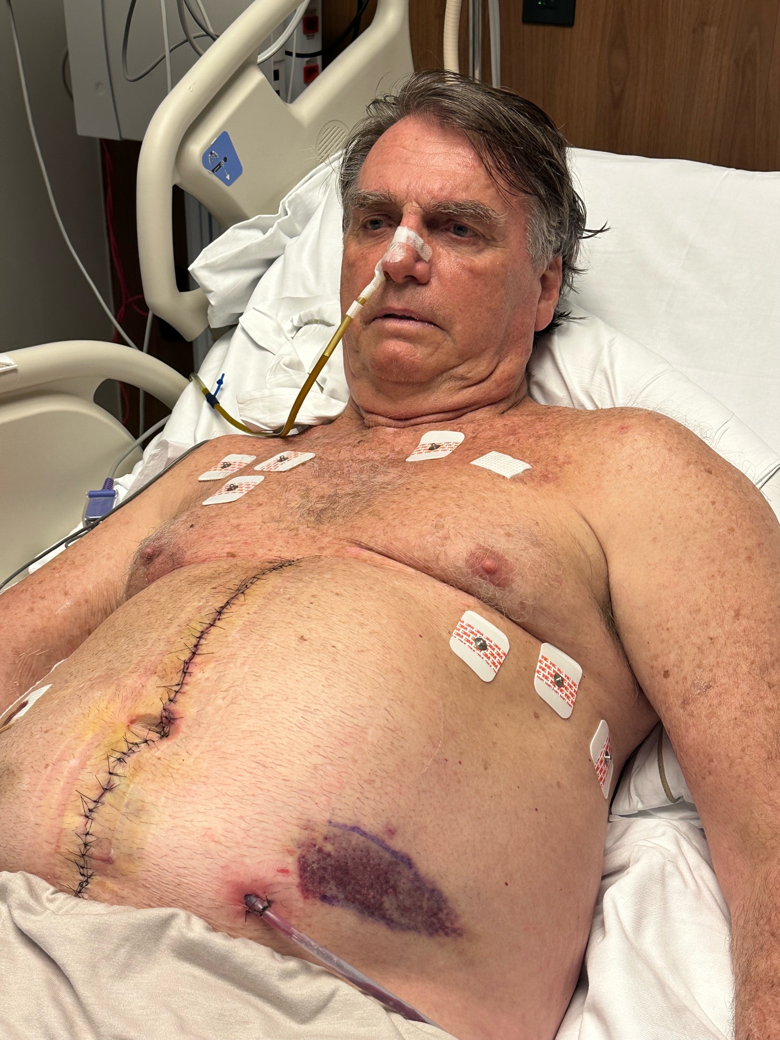 - Sigo internado na UTI do Hospital DF Star, ainda em fase de recuperação após mais um procedimento cirúrgico. Tenho me mantido estável, com a pressão controlada e uma resposta clínica considerada positiva pelos médicos.

- Por enquanto, ainda sigo sem alimentação oral, recebendo nutrição por via venosa, e realizando sessões diárias e mais acentuadas de fisioterapia para acelerar minha recuperação. A recomendação médica é de repouso absoluto, sem visitas, e ainda não há uma data definida para alta da UTI.

- Hoje pela manhã retiraram o curativo na área dos pontos centrais para limpeza e averiguação da situação, além de dreno na lateral esquerda de meu abdômen.

- Agradeço imensamente a todos que têm enviado orações e mensagens de apoio. Elas fazem diferença.

- Brasília, 20 de abril de 2025

- Jair Bolsonaro