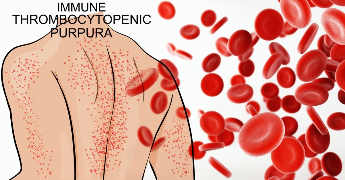 Immune Thrombocytopenia Treatment Market to Witness High Growth from Novel Biologics



 The Immune ...
