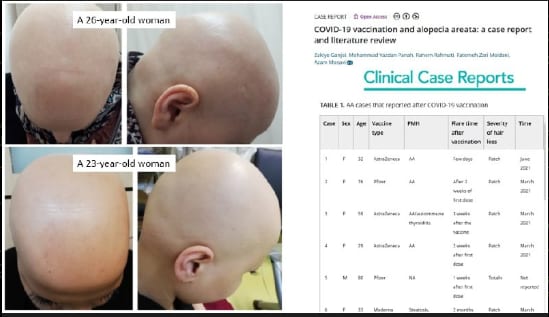 Source:  t.me/s/DrJohnB

September 2022:  COVID-19 vaccination and alopecia areata: 2 cases

https:/...