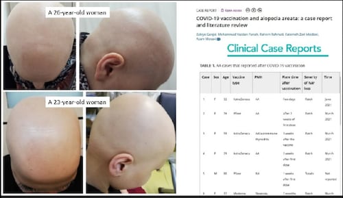 Source:  t.me/s/DrJohnB

September 2022:  COVID-19 vaccination and alopecia areata: 2 cases

https://onlinelibrary.wiley.com/doi/10.1002/ccr3.6039

#AstraZeneca #covid19vaccines @DrNaomiRWolf @DrEddyMD @DailyExposeGB @EpochTimes @LifeSiteNews