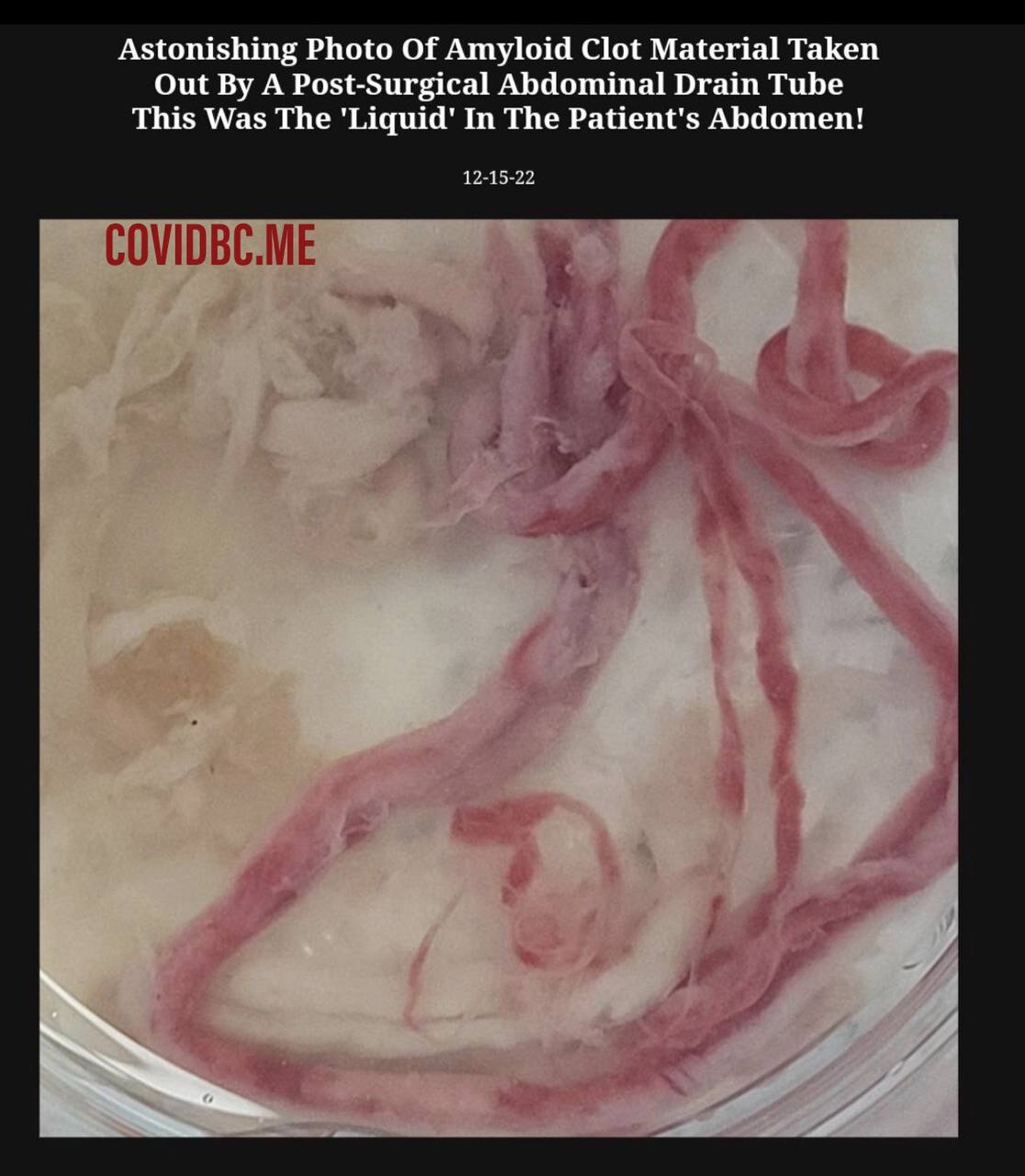 

Astonishing Photo Of Amyloid Clot Material Taken Out By A Post-Surgical Abdominal Drain Tube.
This...